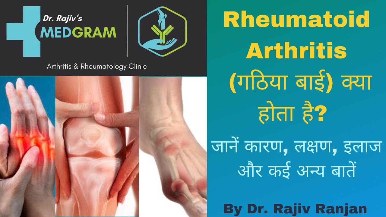 रियुमेटोइड आर्थराइटिस क्या है ?| Rheumatoid Arthritis in Hindi | गठिया बाय क्या है ?