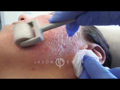 Dermaroller / Microneedling Acne Scars / Skin Resurfacing / Los Angeles, California