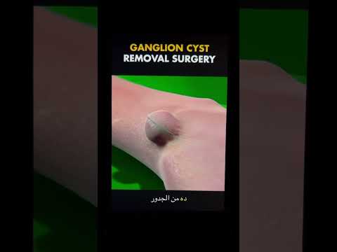 ازاله الكيس الزلاي عن طريق الجراحه كيس الزلالي   طب   
