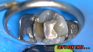 Live: Molar Root Canal Treatment | Tooth Decay Beneath Silver Filling. . .