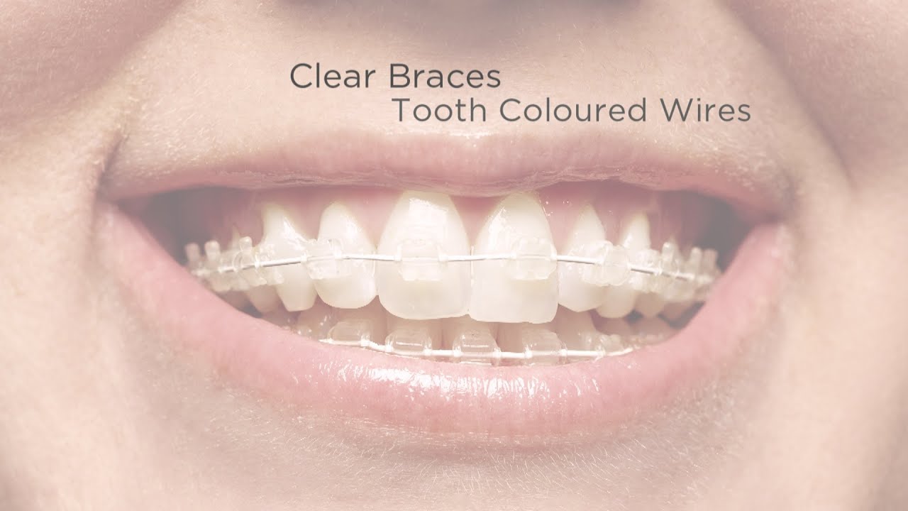 fast tooth straightening six month smiles youtube
