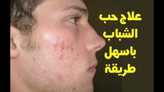 ارخص وصفة حب الشباب و علاجه السريع والتخلص من حب الشباب في الوجه الدهني و علاجه | صحتك بين يديك