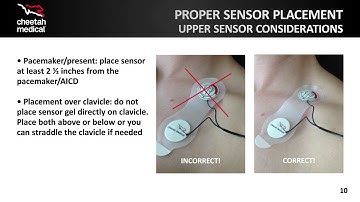 Cheetah Starling™ SV Sensor Placement