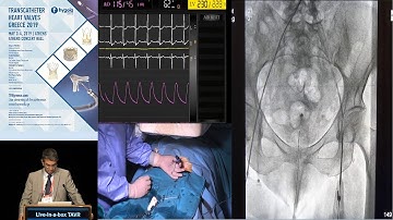 G. Pattakos | Live in a Box | TAVI Session IV – Avoiding Pitfalls