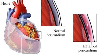 Pericarditis