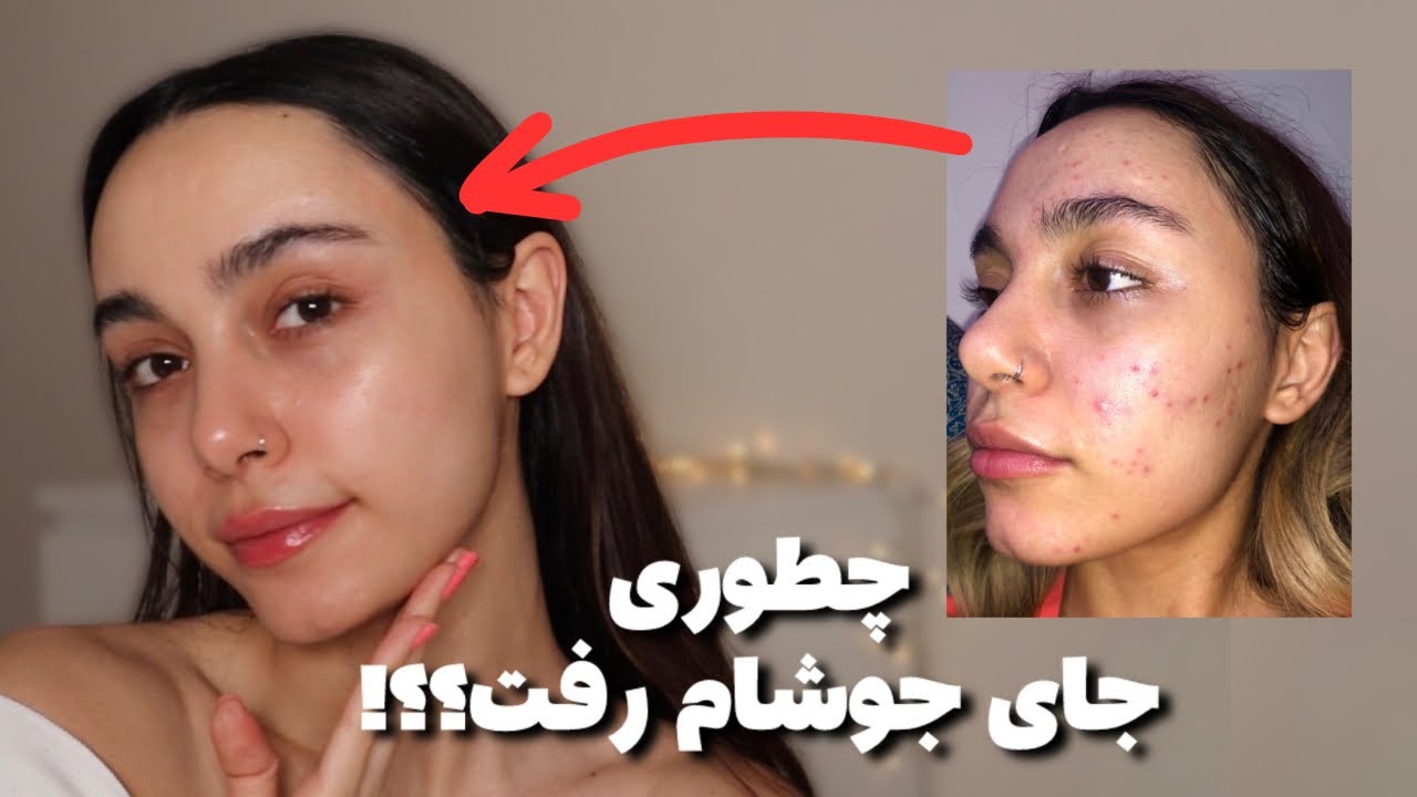 با جای جوش‌هام خداحدافظی کردم🥰روتین پوستی و نکاتی که کسی نمیگه‼️