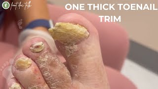 One Thick Toenail Trim