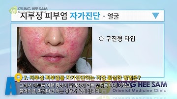 지루성피부염증상 정확한진단, 자가진단 방법, 타입별 분류에 따른 치료