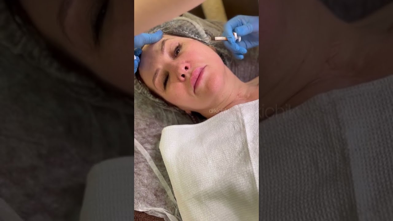 Aliaxin SR / Височный лифтинг 🪄 канюльная техника введения 👩🏻‍⚕️