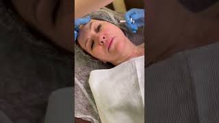 Aliaxin SR / Височный лифтинг 🪄 канюльная техника введения 👩🏻⚕️