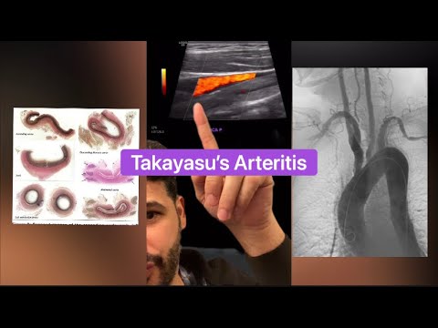 Takayasu’s Arteritis - Case Review