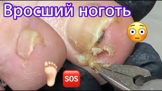 Вросший ноготь 🦶🏻⚠️❗️🆘