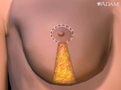 How Breast Lift Works Animation -  Breast Reduction Procedure Video