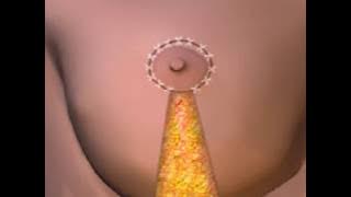 How Breast Lift Works Animation -  Breast Reduction Procedure Video