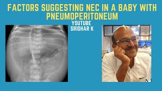 What features suggest NEC in neonatal gut perforation with pneumoperitoneum? #SIP #NEC #perforation