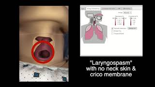 Hi-tech manikin's airway features (3): Pharyngeal obstruction & laryngospasm. screenshot 4
