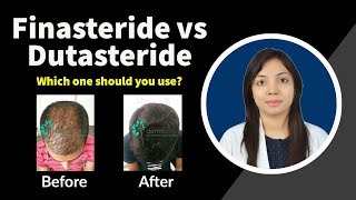 Finasteride vs Dutasteride: Which is better? |  Finasteride and Dutasteride Side Effects