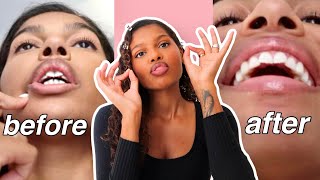 How I Straightened My TEETH | affordable braces