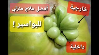 علاج البواسير الداخلية والخارجية في المنزل / وصفة طبيعية مجربة