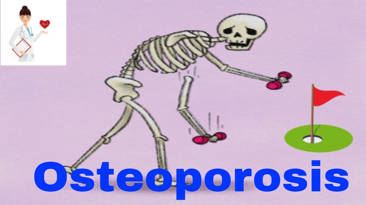 Board Osteoporosis 1 YouTube