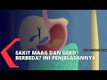 Apa Perbedaan Maag dan Gerd? Begini Penjelasannya