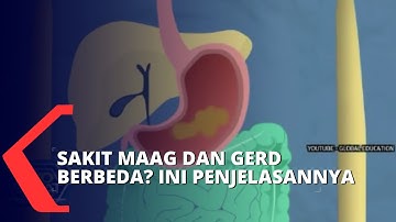 Apa Perbedaan Maag dan Gerd? Begini Penjelasannya