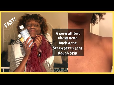 CLEAR BODY ACNE FOREVER| How to clear chest acne, back acne, and strawberry legs!| Natural Products