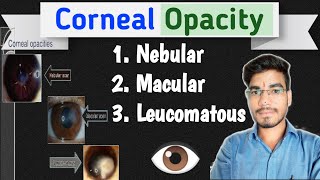 Corneal Opacity The Cornea M.k.sharma Ophthalmic Education Ophthalmology