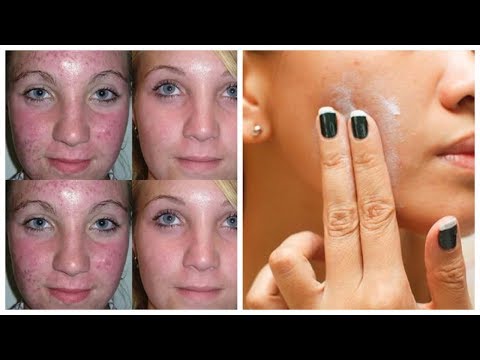 Ретин А (Retin A) - от прыщей, наши рекомендации, предупреждения, побочки