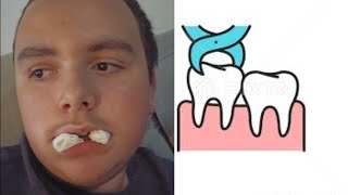 After the procedure... Wisdom Tooth Surgery Series Pt.1