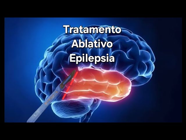 Tratamento Ablativo Epilepsia