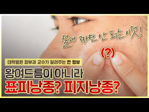 딱딱한 여드름? 뾰루지? 🤷‍♀️헷갈려서 짜면 큰일 나는 💀표피낭종💀 - [언니네피부과]