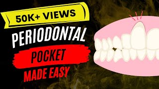 Periodontal disease : Periodontal pocket
