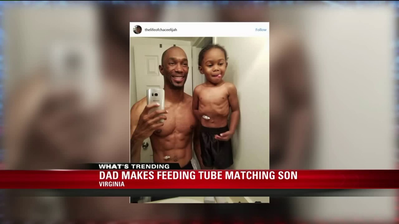170613121 Dad Glues On Feeding Tube To Match 3 Year Old Son 170613121 Dad Glues On Feeding Tube To Match 3 Year Old Son