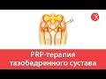 PRP-терапия тазобедренного сустава