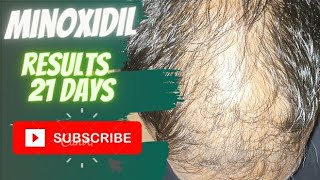 minoxidil results in indiA after 21 dys60 days result link in description...