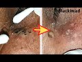 【角栓除去】綿棒で！大量のニキビを芯出しするのって気持ちいい／Blackhead Removal Show