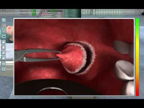 Video: Tonsillektomi: Formål, Procedure Og Bedring