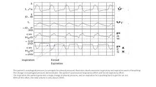 Exercises in Ventilator Waveform Analysis -- Exercise # 7