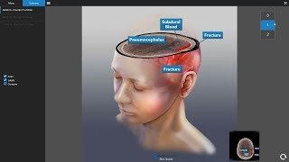 Interactive Brain Injury Exhibit Diagnoses Depth of TBI