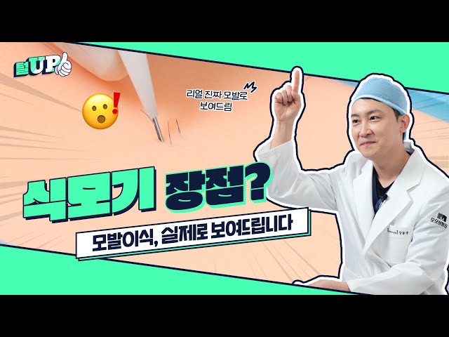 모발이식 하는 방법 실제로 보여드려요!ㅣ식모기 방식ㅣ모모성형외과, 모모의원ㅣ강동우원장ㅣ모제림성형외과 출신ㅣ