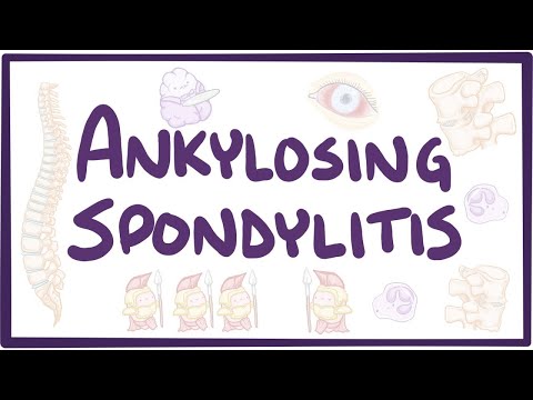 Video: Ar ankilozuojantis spondilitas rimtas?