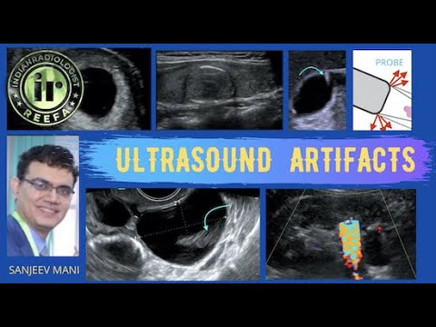 MedPix Case - Nephrolithiasis with 