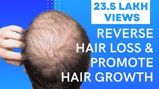 5 Easy Ways To Reverse Hair Loss &amp Promote Hair Growth