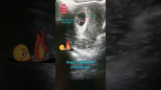 Early Pregnancy Ultrasound.الحمل المبكر.fypviraltrendingshortsforyou