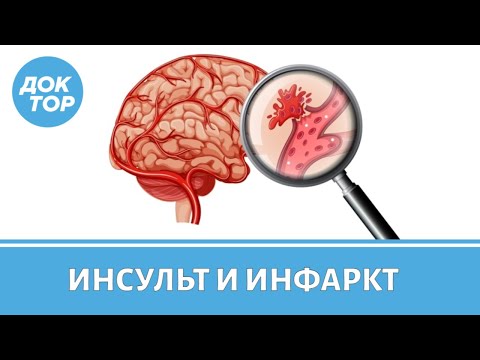 Какая разница между инсультом и инфарктом, что такое микроинсульт