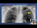 Chest X-Ray Normal And Variants