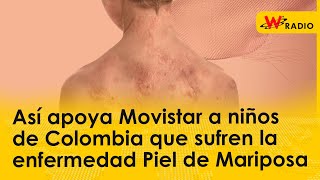 Así apoya Movistar a niños de Colombia que sufren la enfermedad Piel de Mariposa