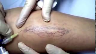 Espuma escleroterapia varices