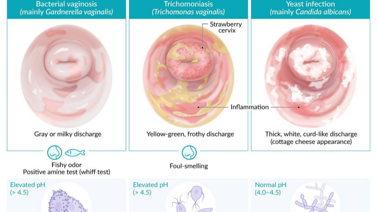 Vaginal Discharge & STDs in virgins (Family medicine Gynecology) 🎓 ...